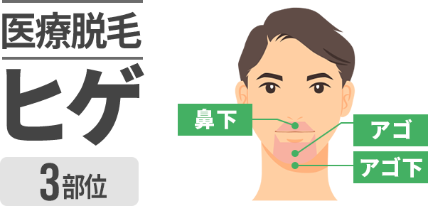 医療脱毛ヒゲ3部位（鼻下・アゴ・アゴ下）を示す男性の顔の説明イラスト