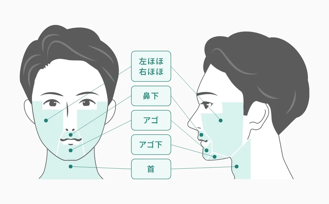 ヒゲ脱毛全部位